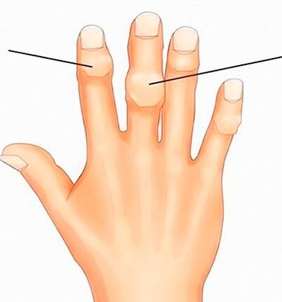 Heberden és Bouchard csomópontok az interphalangealis ízületeken arthrosisban