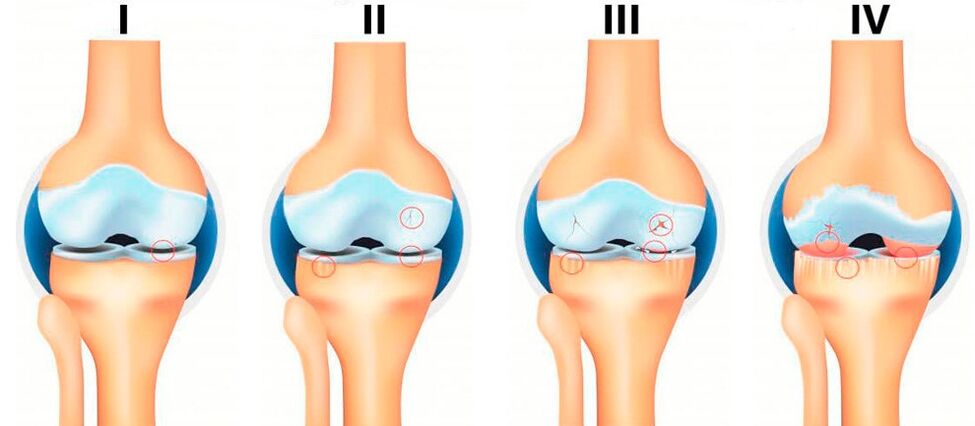az arthrosis szakaszai