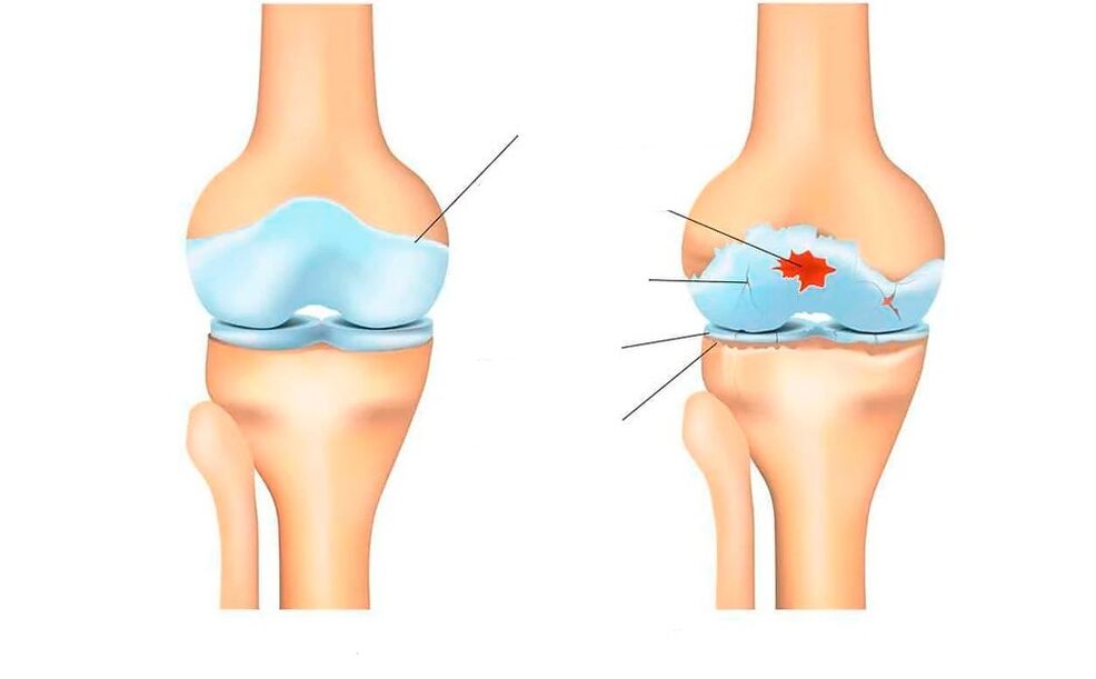 egészséges ízület és arthrosis esetén