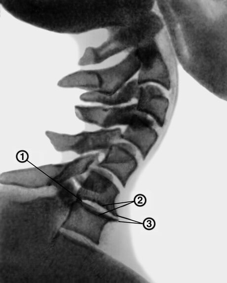A nyaki gerinc röntgenfelvétele osteochondrosissal