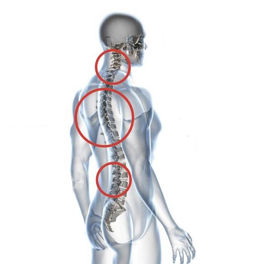Hogyan nyilvánul meg az osteochondrosis