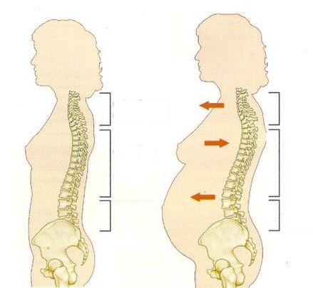 osteochondrosis terhesség alatt